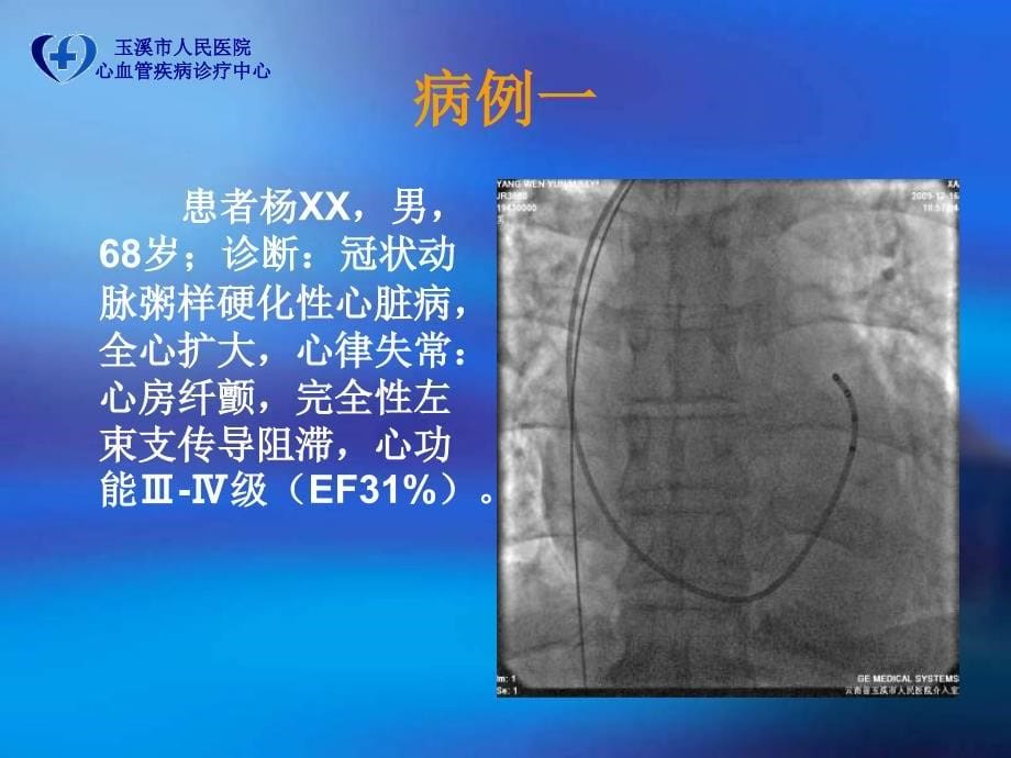 左室电极植入时不同投射角度的应用_第5页