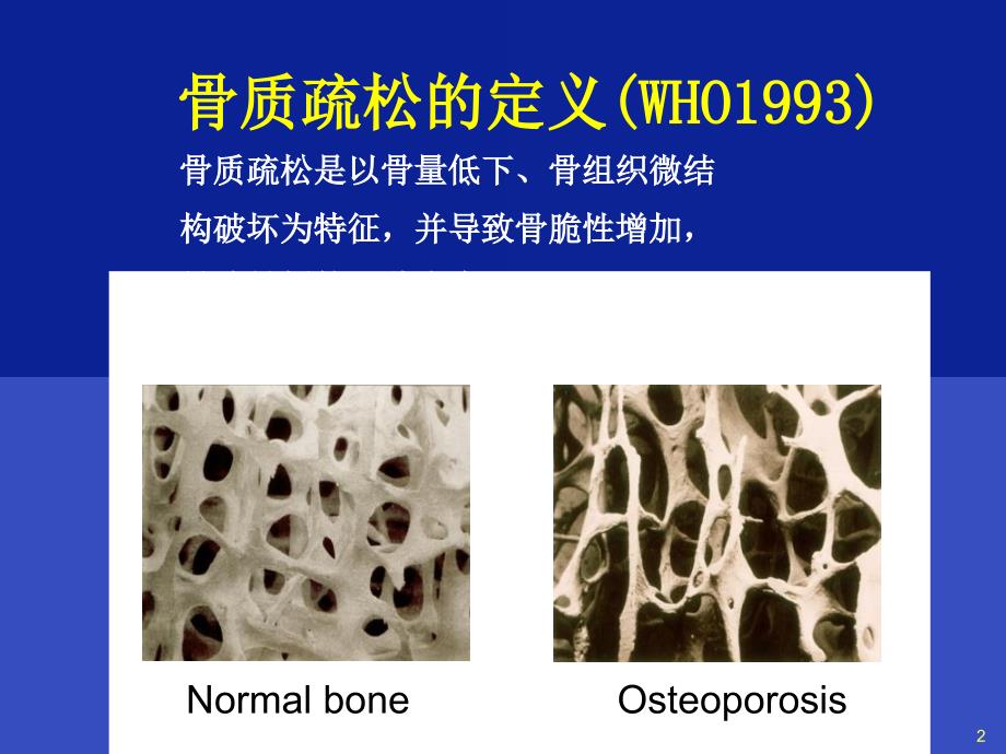 骨质疏松诊治与中医药课件_第2页