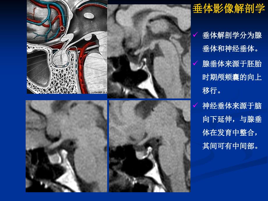 鞍区病变影像诊断.ppt_第3页