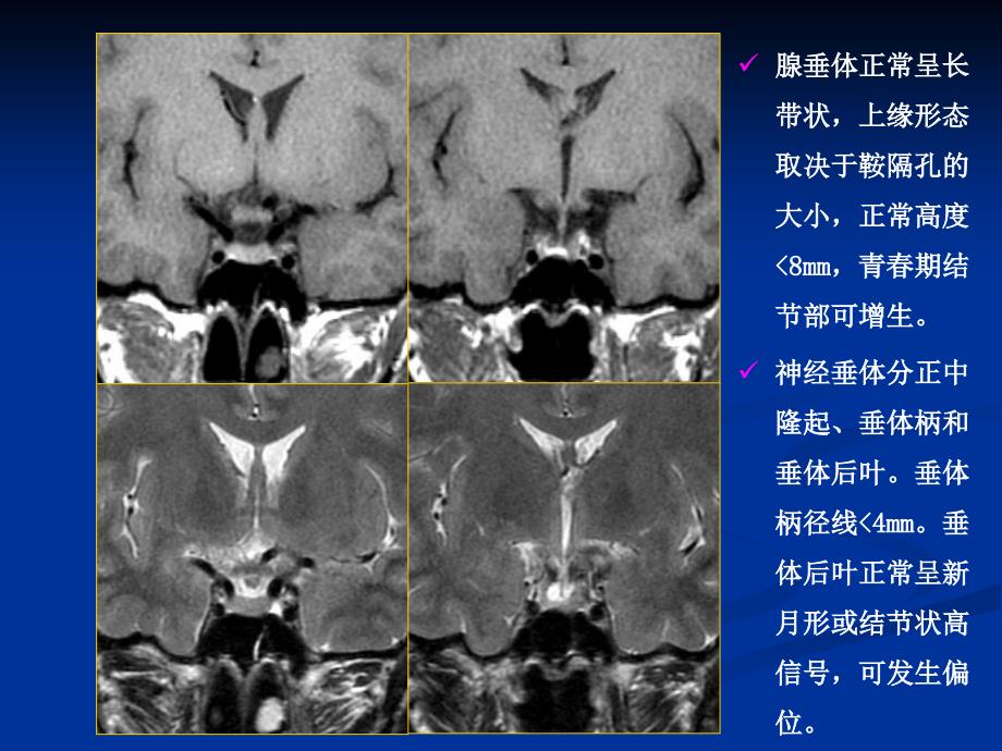 鞍区病变影像诊断.ppt_第4页