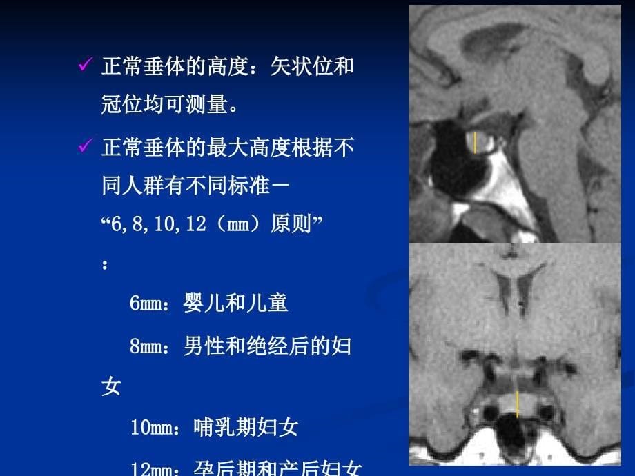 鞍区病变影像诊断.ppt_第5页