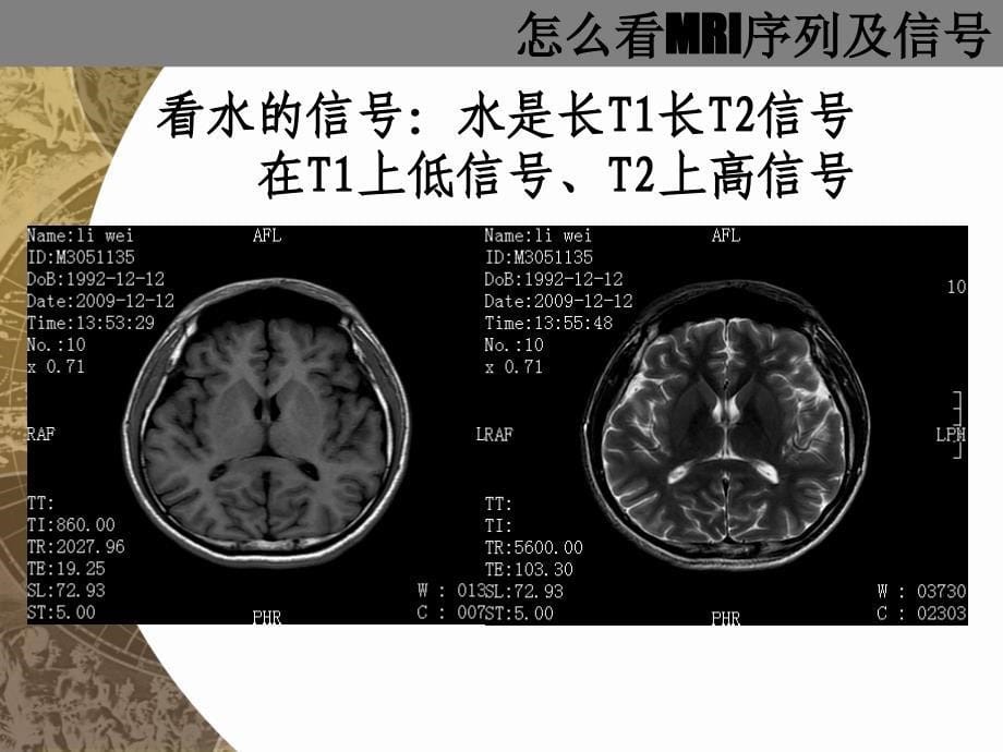 医院培训课件：怎么看MRI片_第5页