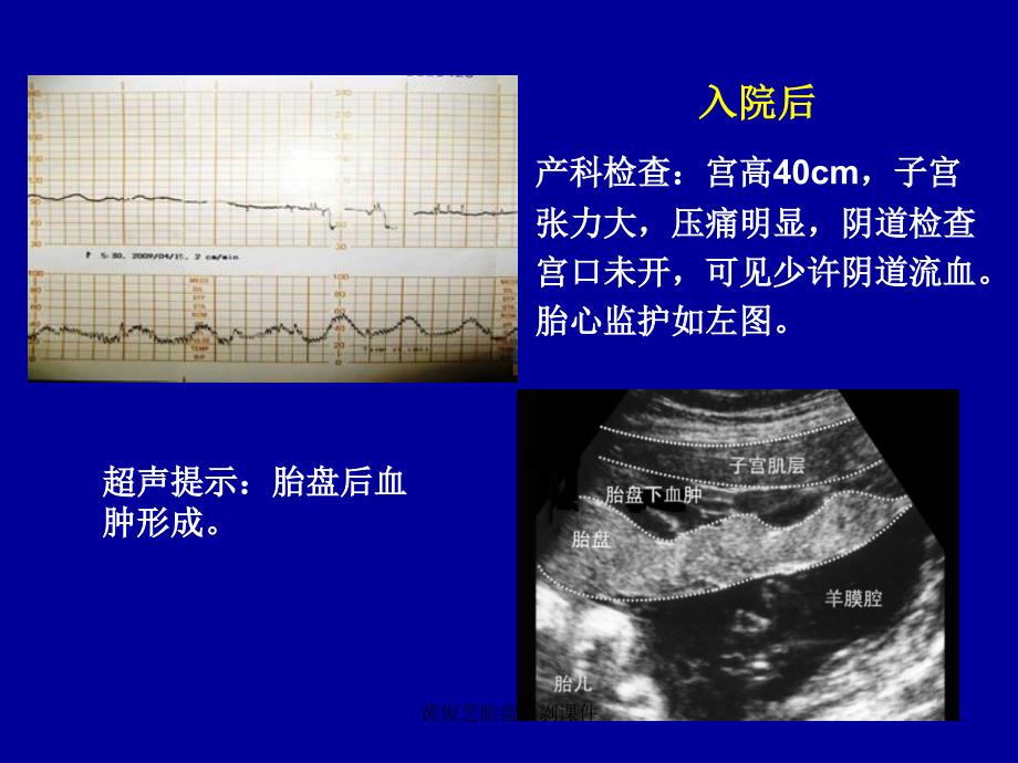 黄俊芝胎盘早剥课件_第2页