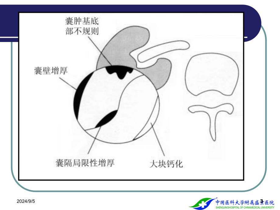 泌尿系统肿瘤PPT课件_第3页