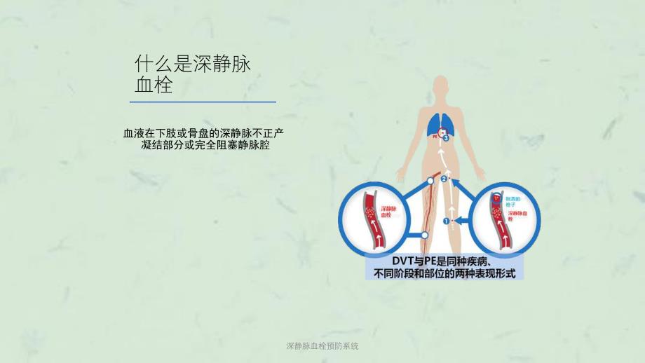 深静脉血栓预防系统课件_第4页