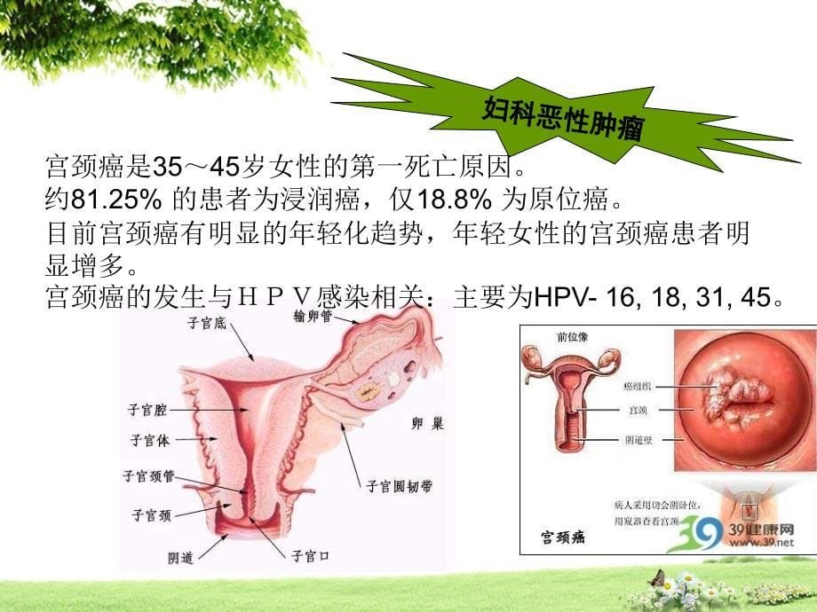 宫颈癌护理查房资料_第5页