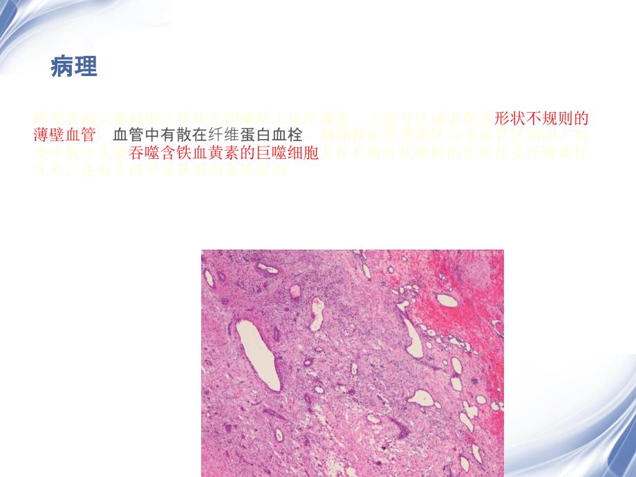 医学影像出血坏死性鼻息肉PPT文档_第3页