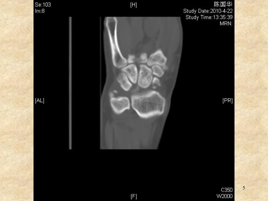 舟状骨骨折PPT医学课件.ppt_第5页