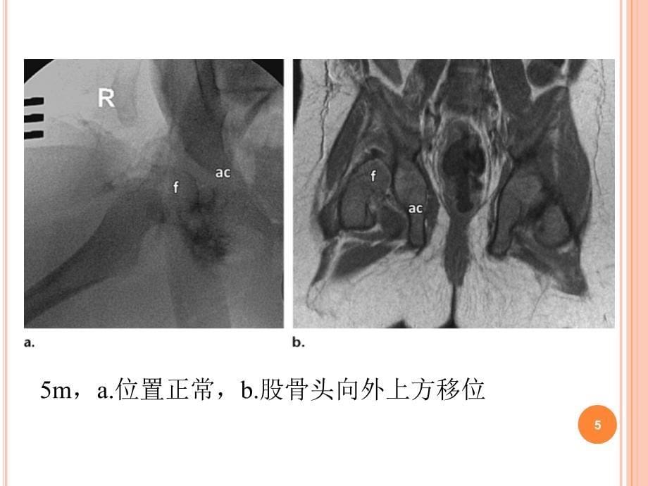 MR成像在髋关节发育不良复位后评价中的临床应用.ppt_第5页