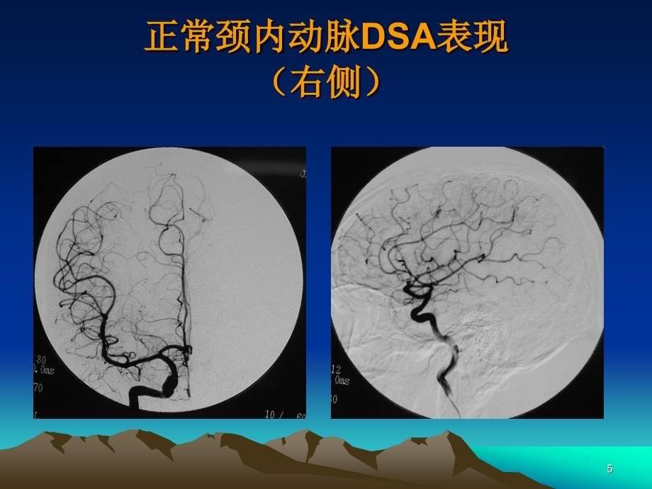 如何阅读神经系统DSA片ppt课件_第5页