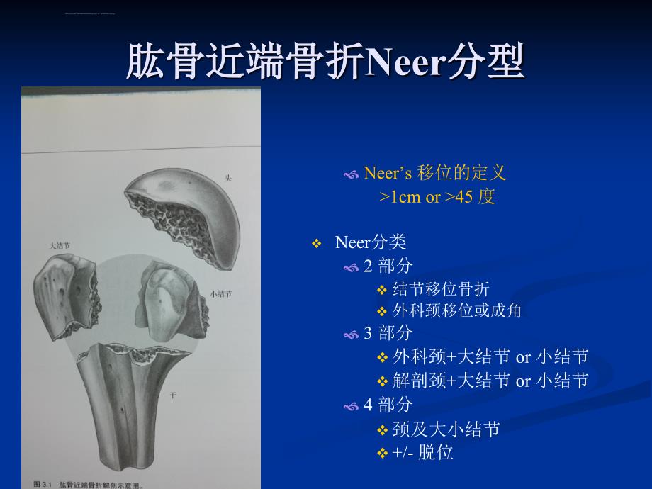 肱骨近端骨折Neer分型及治疗ppt课件_第4页