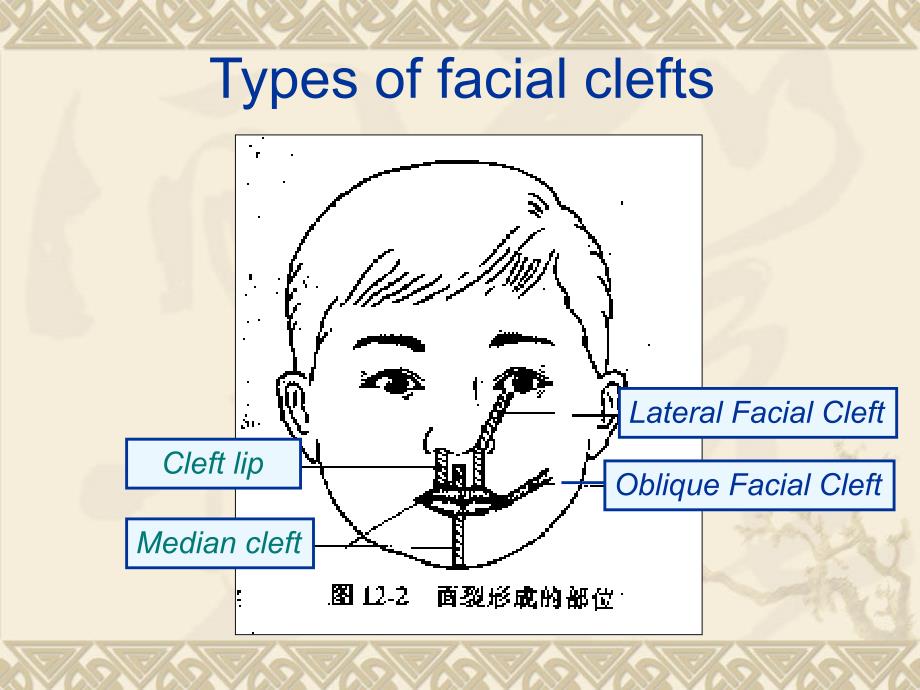 唇裂腭裂CLEFT LIP AND PALATE.ppt_第4页