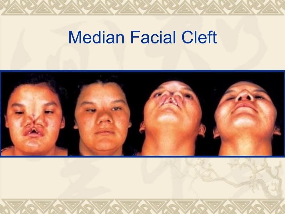 唇裂腭裂CLEFT LIP AND PALATE.ppt_第5页