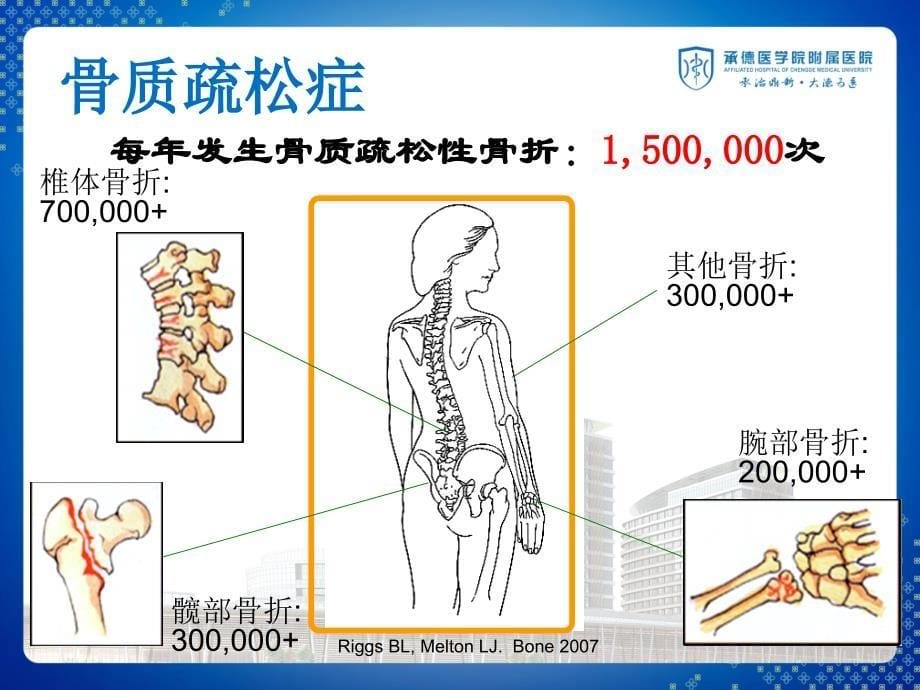 骨质疏松症与骨密度_第5页