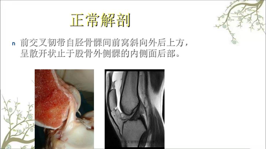 膝关节前交叉韧带损伤MRI诊断_第2页