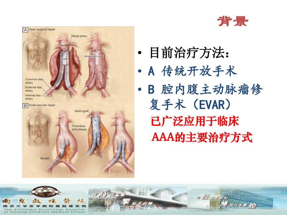 杂交手术技术治疗胸腹主动脉瘤_第3页