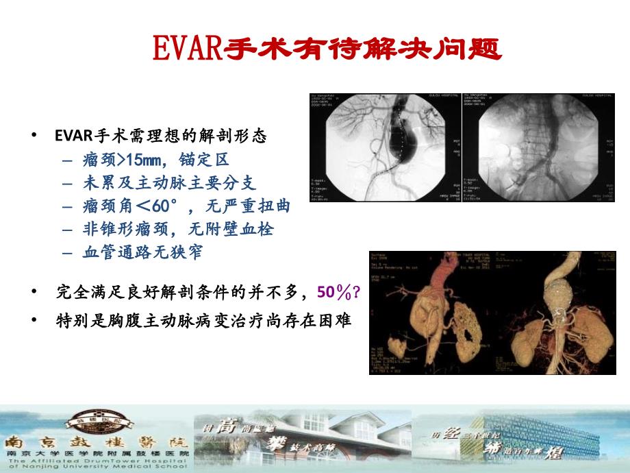 杂交手术技术治疗胸腹主动脉瘤_第4页