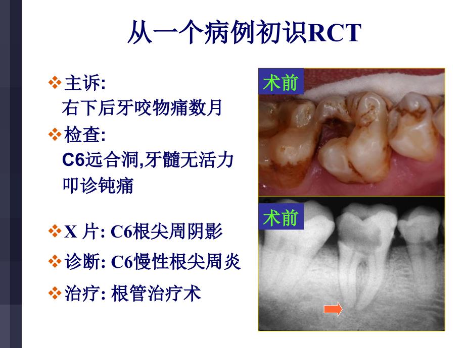 根管治疗步骤方法器械_第4页