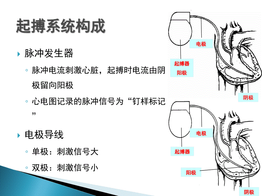 常见起搏心电图的分析_第4页