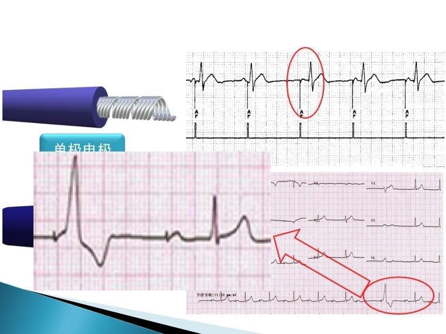 常见起搏心电图的分析_第5页