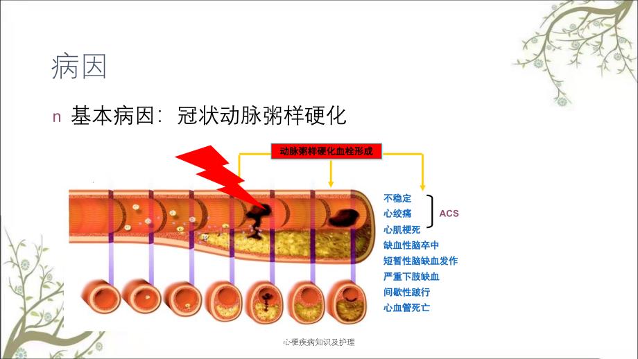 心梗疾病知识及护理_第3页