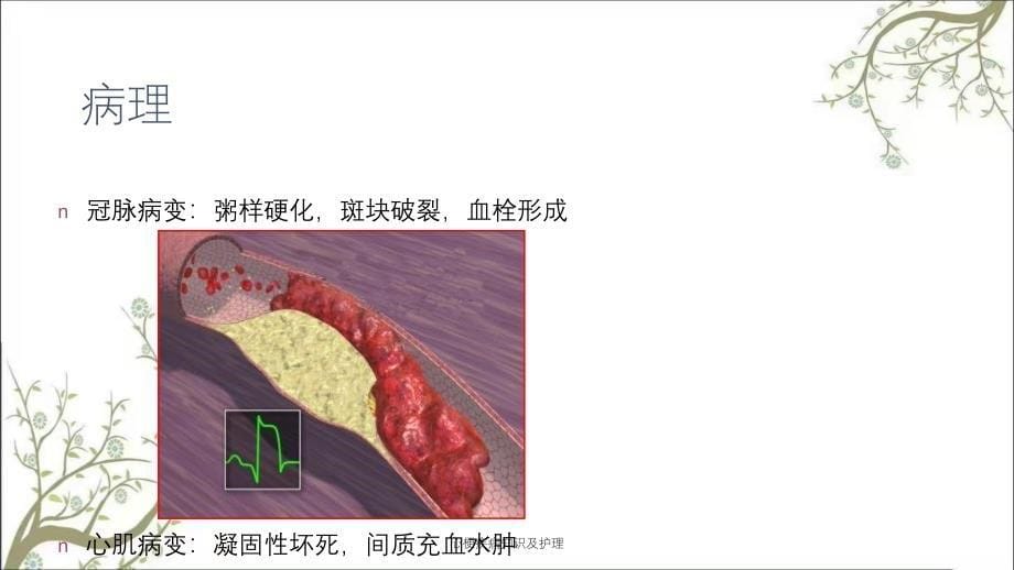 心梗疾病知识及护理_第5页