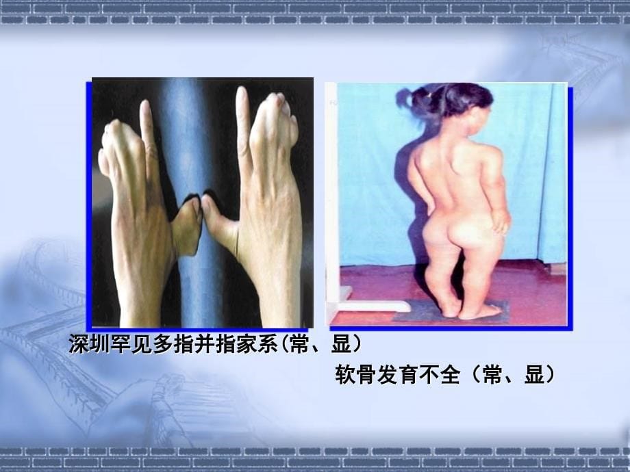 人类遗传病和遗传病的预防.ppt_第5页