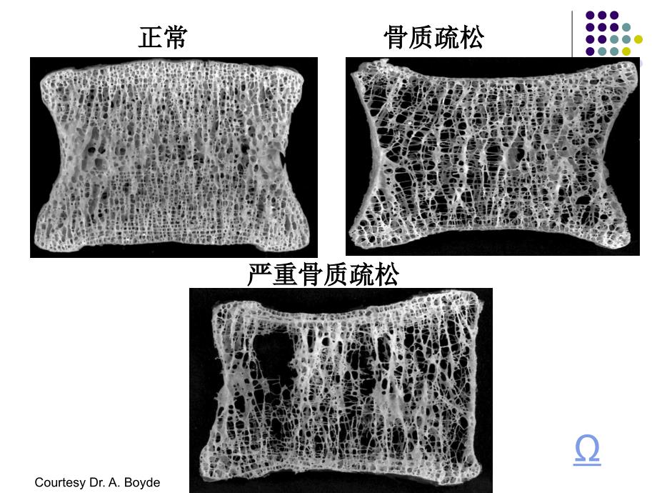 骨质疏松病人的护理ppt课件.ppt_第4页