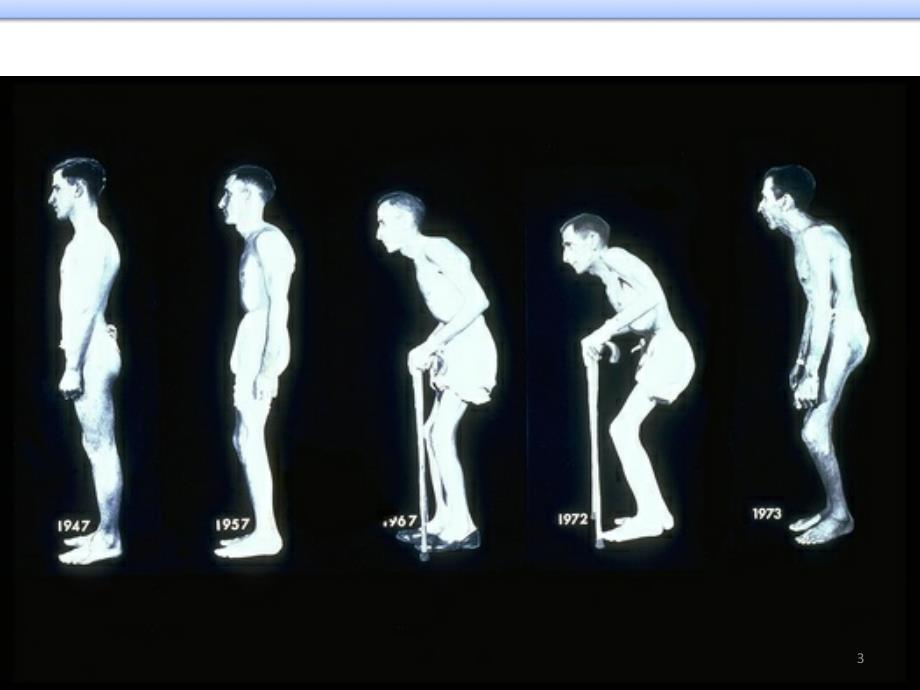强直性脊柱炎基础与临床参考PPT_第3页