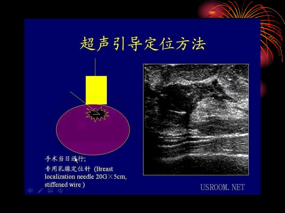 乳腺肿块超声诊断.ppt_第4页