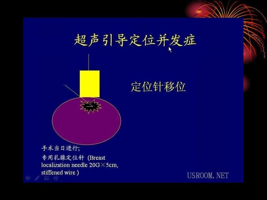 乳腺肿块超声诊断.ppt_第5页