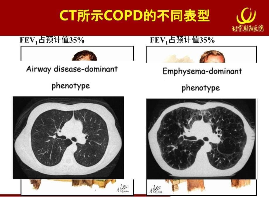 慢阻肺规范化诊治慢阻肺临床表型与治疗_第5页