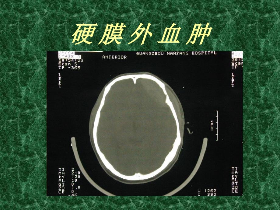 中枢神经系统CTMR诊断外伤ppt课件_第4页