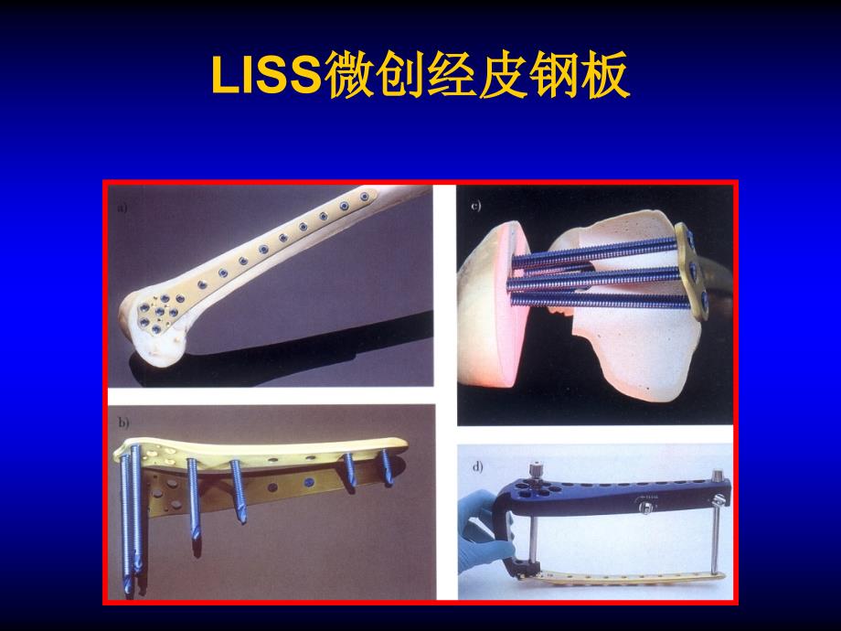 《liss病例报告》PPT课件_第2页