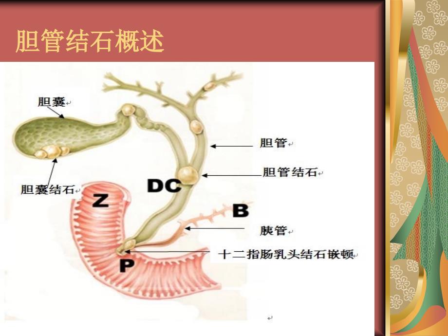 ercp治疗胆总管结石的护理_第4页