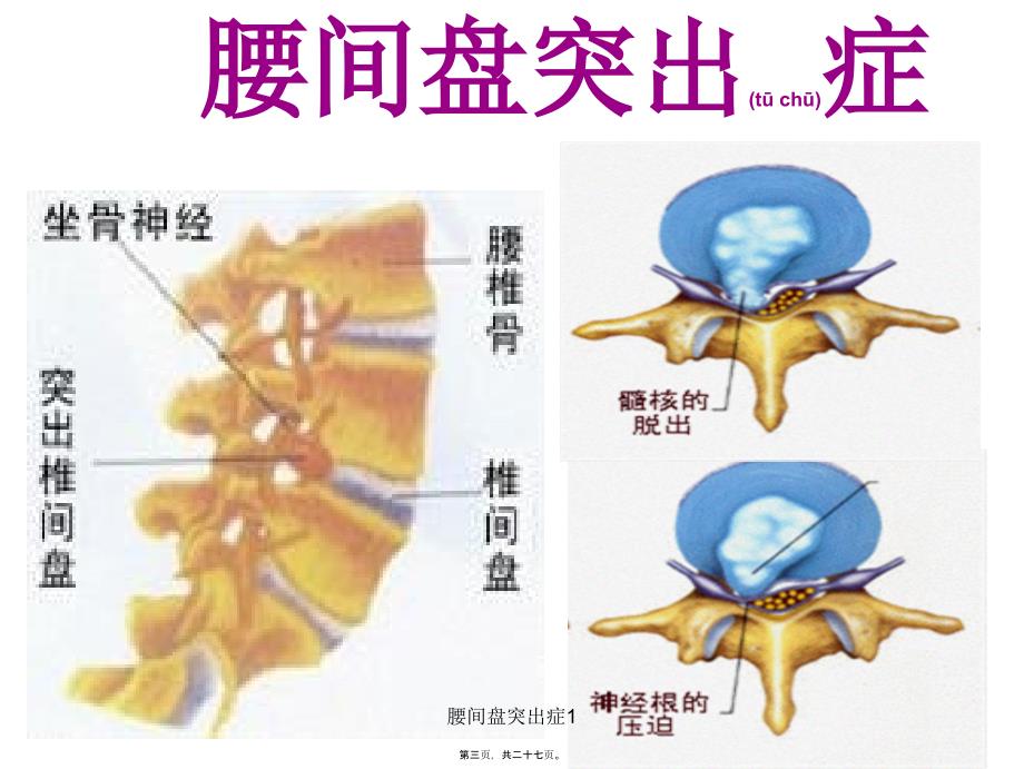 腰间盘突出症1课件_第3页