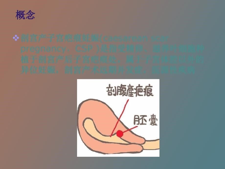 剖宫产子宫瘢痕妊娠_第5页