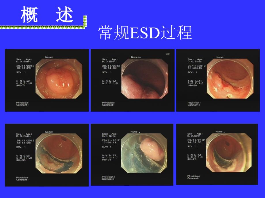 胃ESD术后出血的防治_第2页