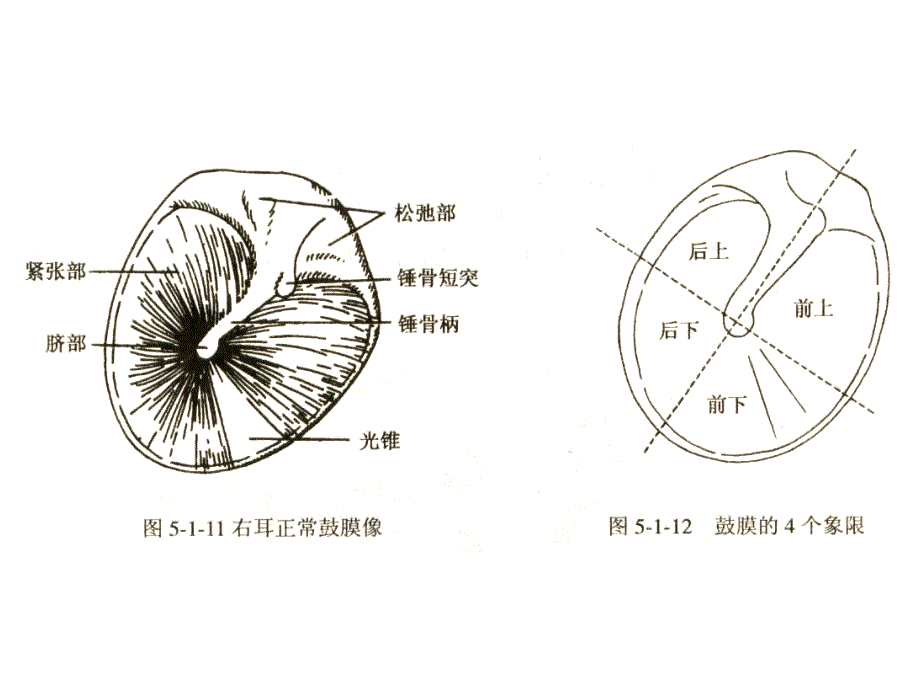 化脓性中耳炎及其并发症.ppt_第3页