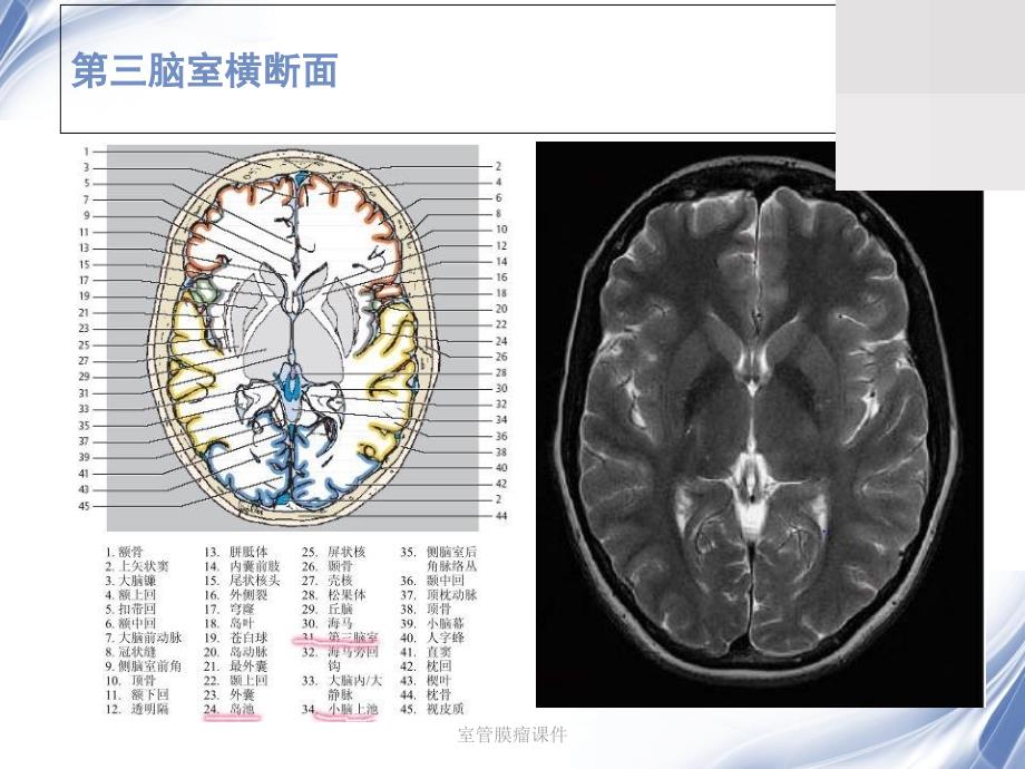 室管膜瘤课件_第4页