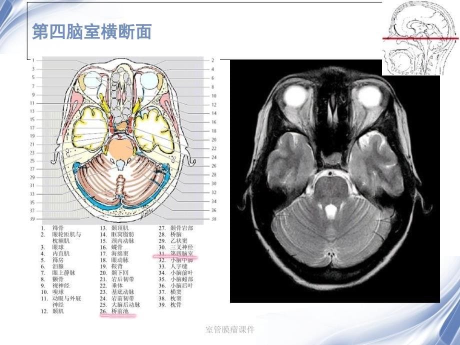 室管膜瘤课件_第5页