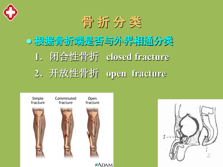 骨折病人的护理ppt_第4页