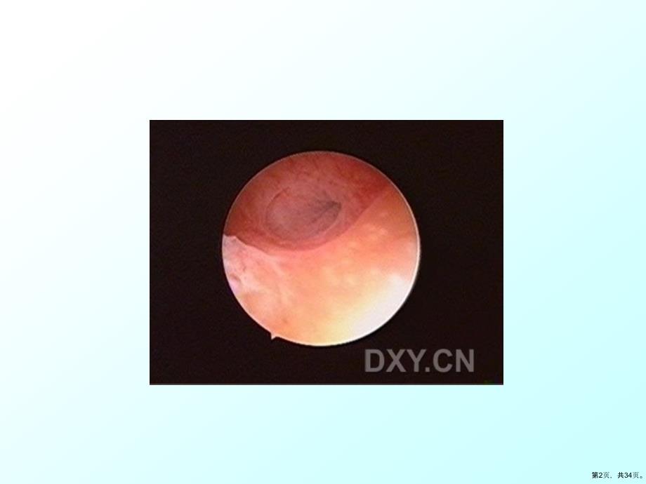 宫腔镜图片教学课件_第2页