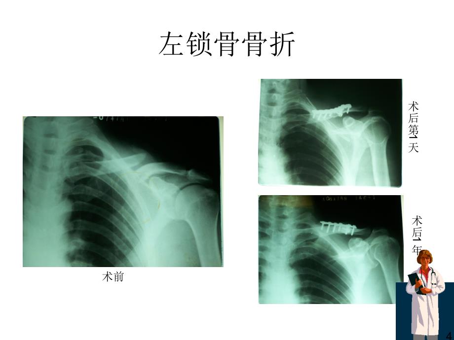 骨折X线片汇总_第4页