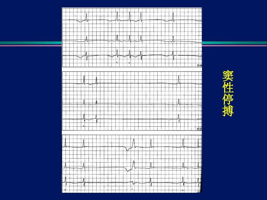 临时起搏器安装基本技巧_第3页