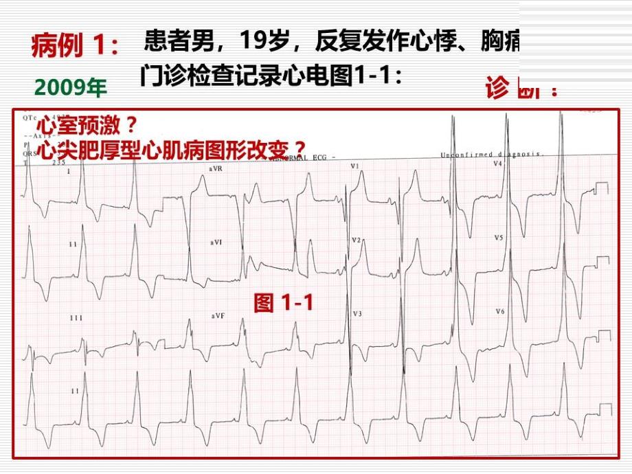 预激与遗传代谢性心肌病课件_第2页