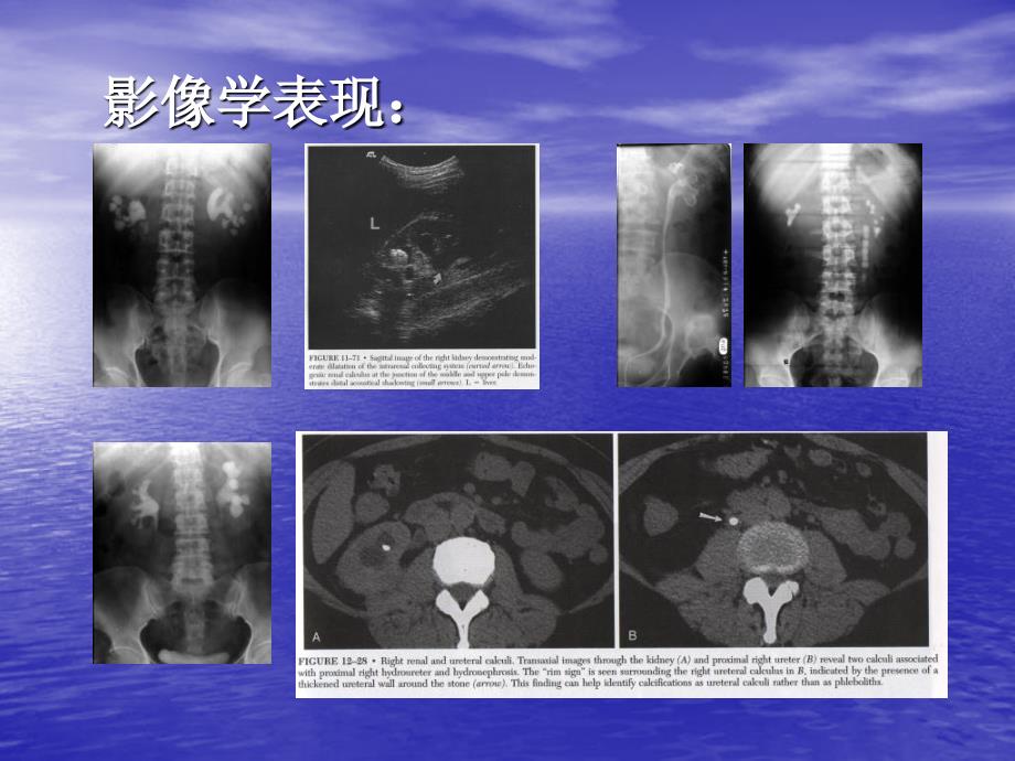 尿石症的微创治疗进修课_第3页