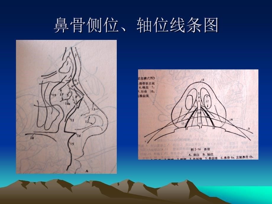 临床急诊影像诊断之鼻骨骨折_第5页