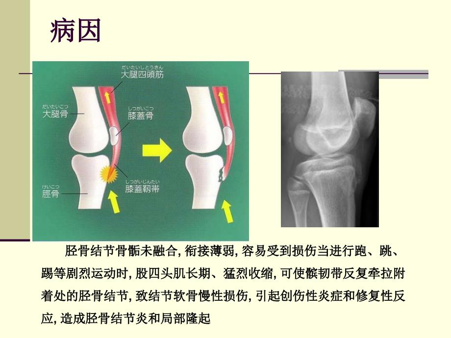 胫骨结节骨软骨炎(OSD)课件_第4页