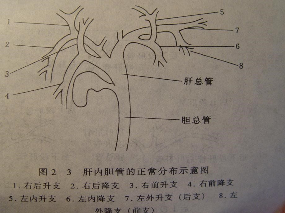 胆石症病人的护理课件_第5页